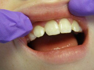 After Composite restoration