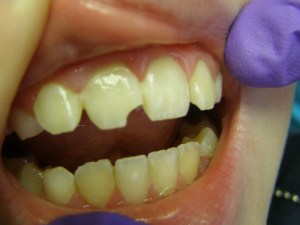 Before Composite restoration