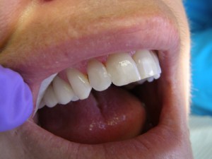 After Composite restoration