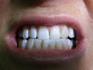 After Zoom Whitening